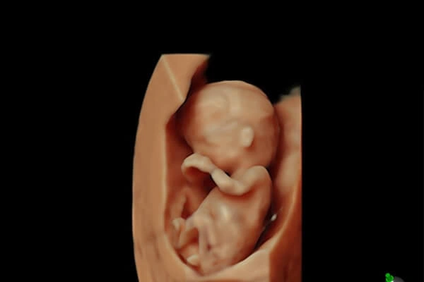 1erTrimestre Embarazo